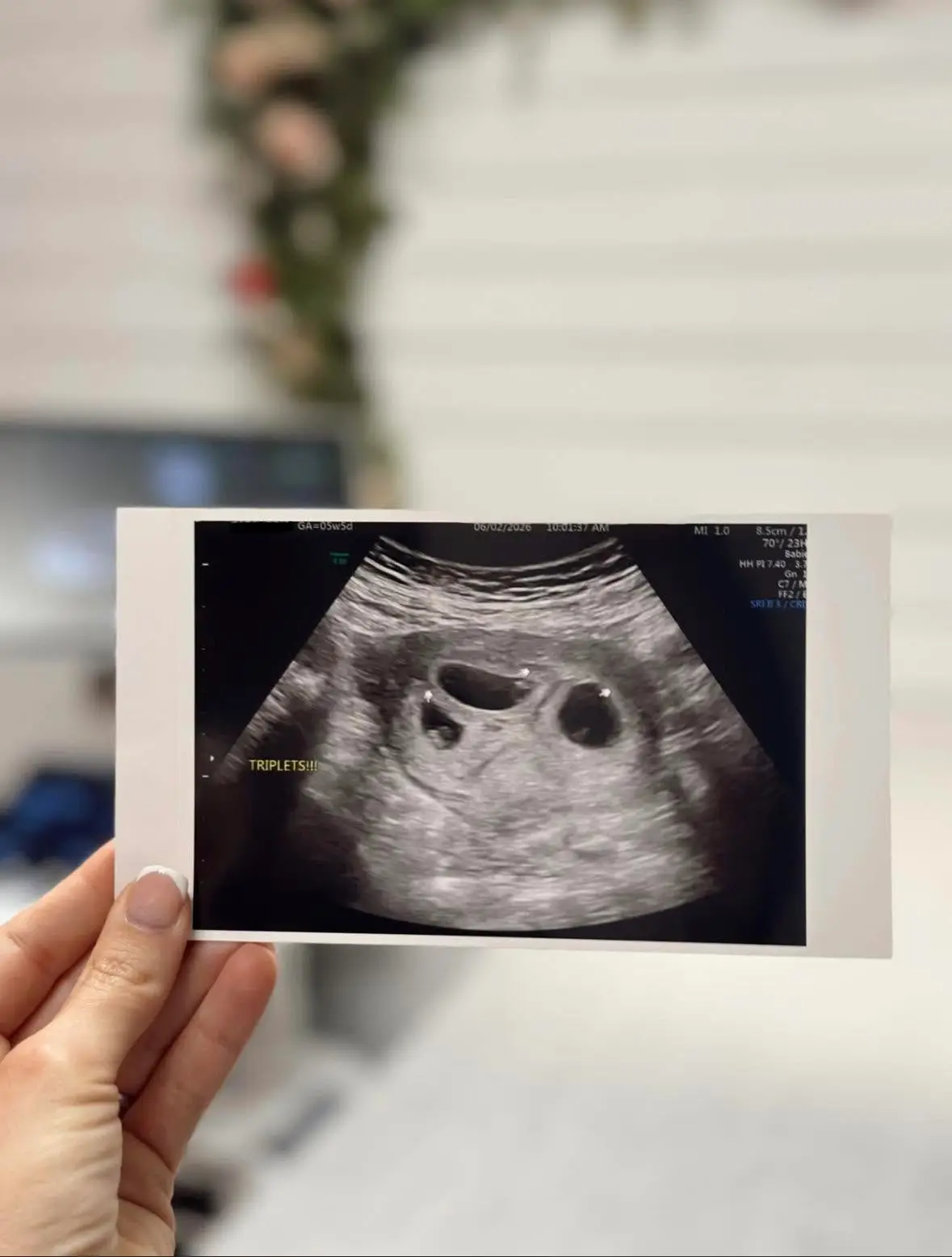 3D ultrasound image of fetus, expectant parents bonding experience